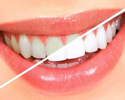 Nipomo Dentist - Whitening Teeth